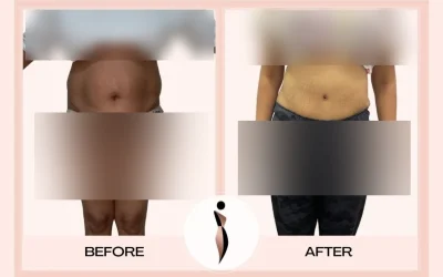 Lipoabdominoplasty Before And After