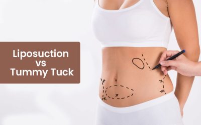 Liposuction Or Tummy Tuck – Which way do I go?