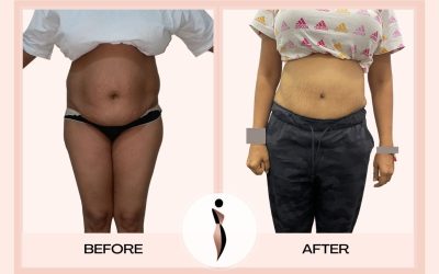 Lipoabdominoplasty Before And After