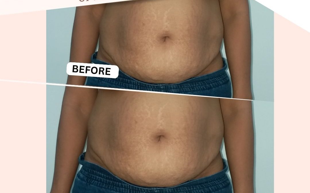 Lipoabdominoplasty Surgery Before And After