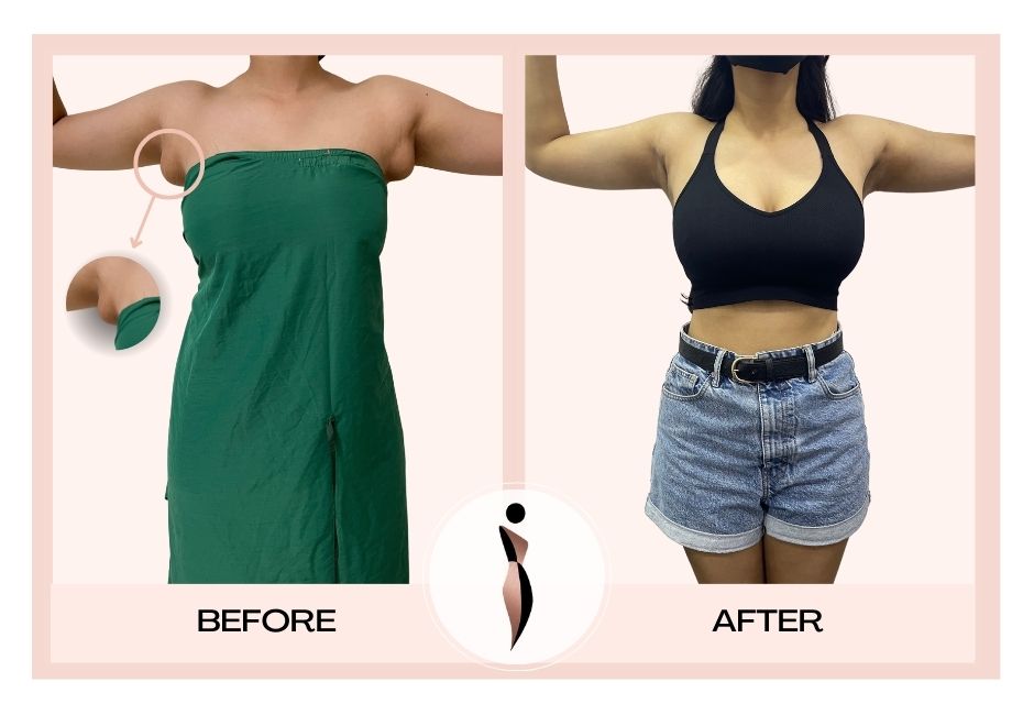ACCESSORY BREASTS BEFORE AND AFTER RESULT