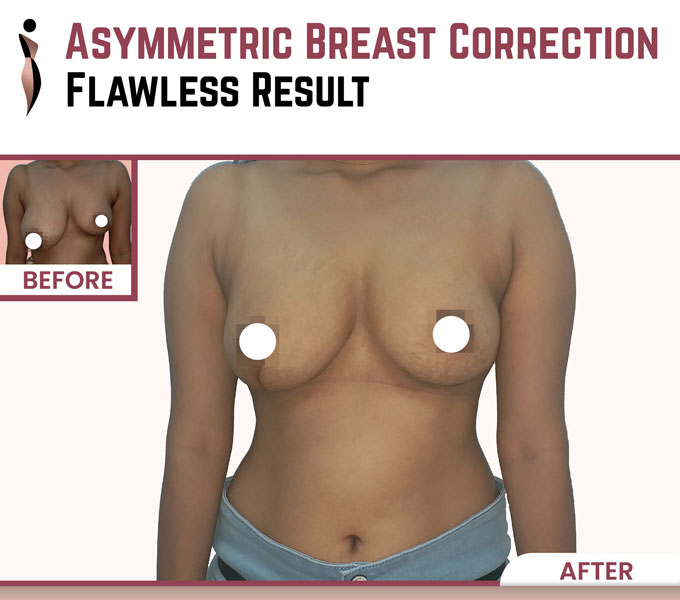 CORRECTION OF ASYMMETRIC BREASTS