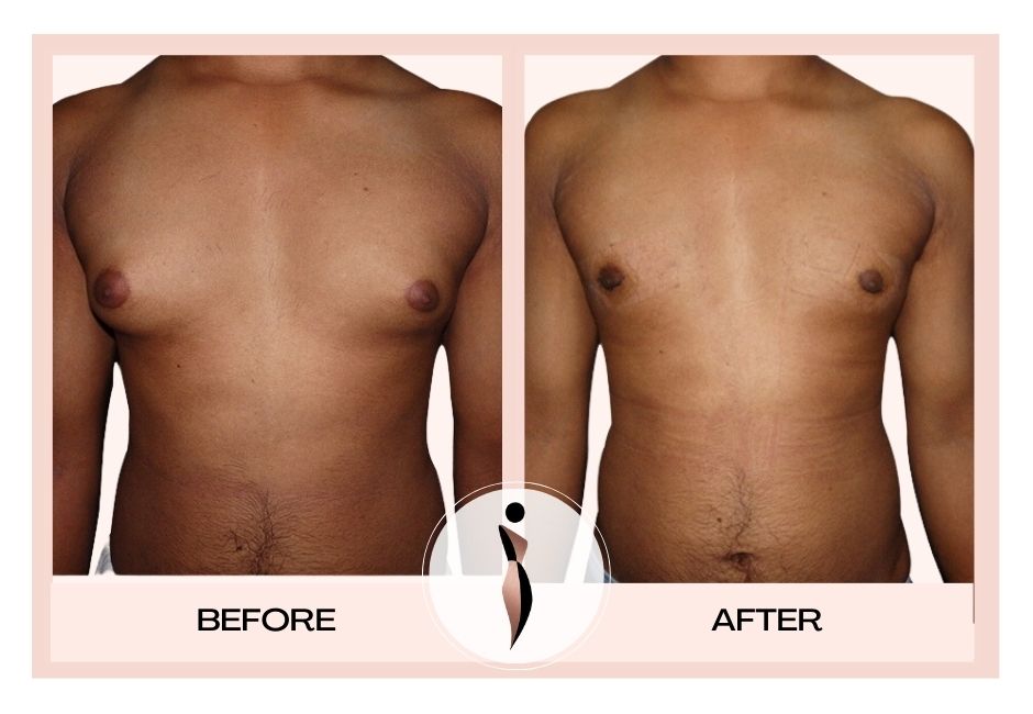 Gynaecomastia before and after results