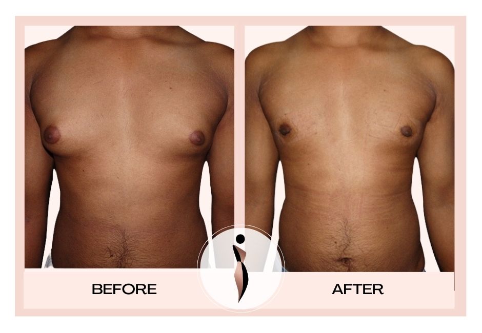 Breast Augmentation in Mumbai