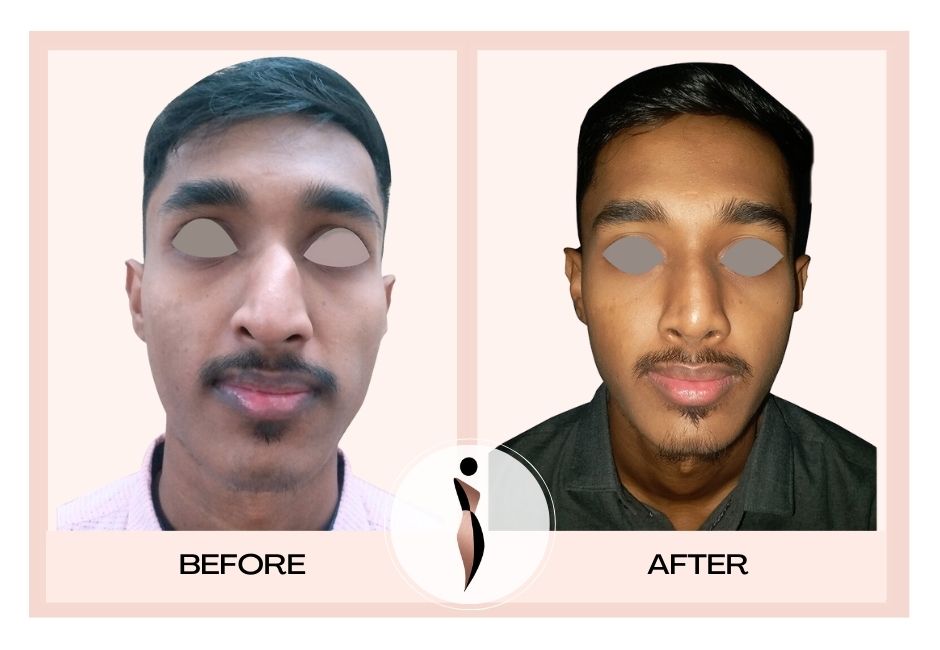 best rhinoplasty surgeon in mumbai