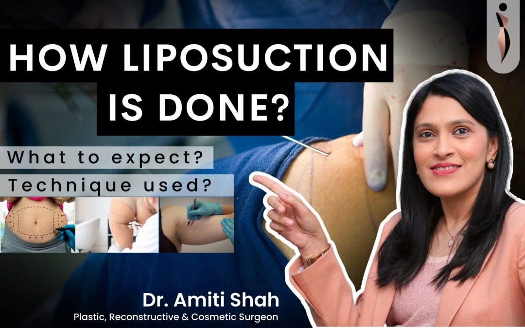 How to Prepare for Liposuction