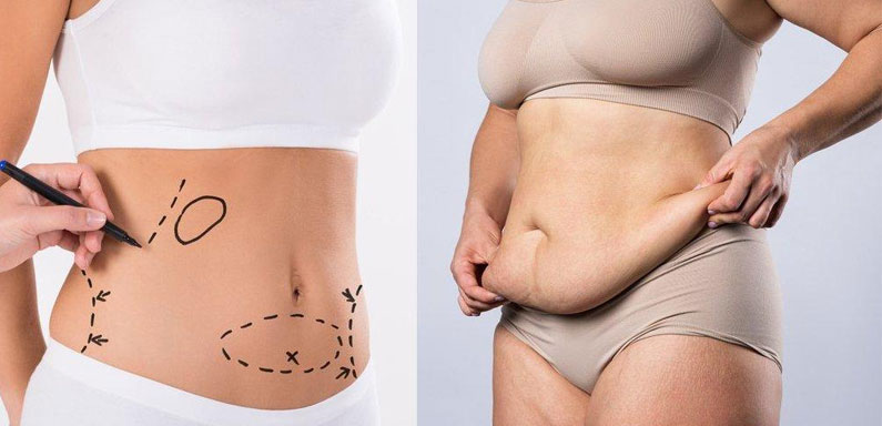 Liposuction and Tummy Tucks