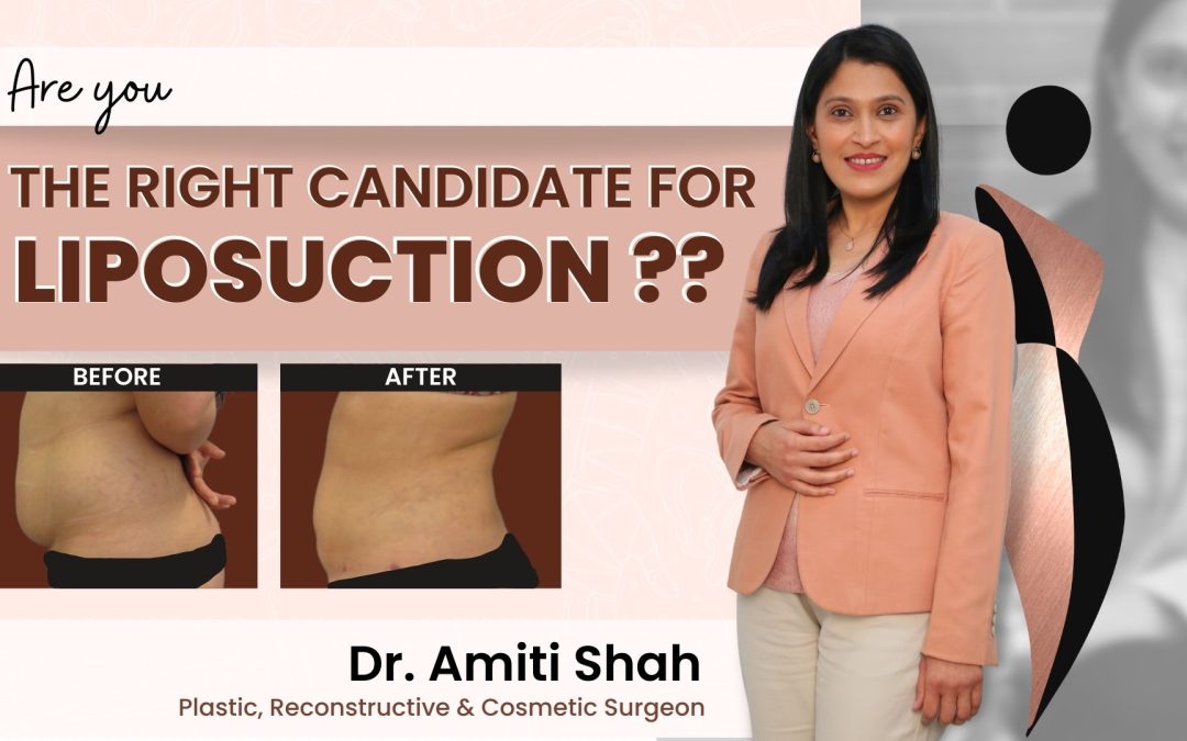 Are you the right candidate for liposuction