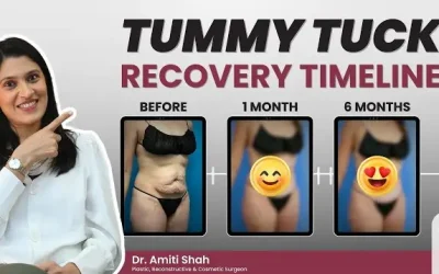 Tummy Tuck Recovery: Step-by-Step What to Expect After 1 Week, 1 Month and 6 Months