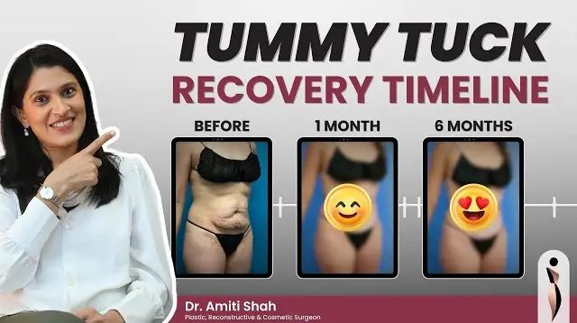 Tummy Tuck Recovery: Step-by-Step What to Expect After 1 Week, 1 Month and 6 Months