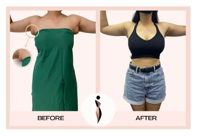 ACCESSORY BREASTS-BEFORE AFTER