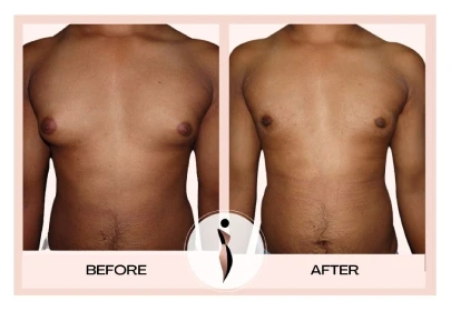 Gynecomastia Before After