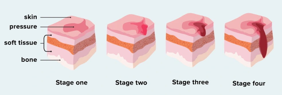 Stages of Bed Sores