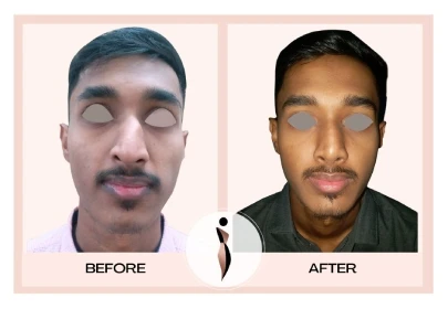 Rhinoplasty Before After Results